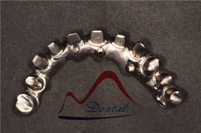 Nobel Dental Implant Bridge (2)