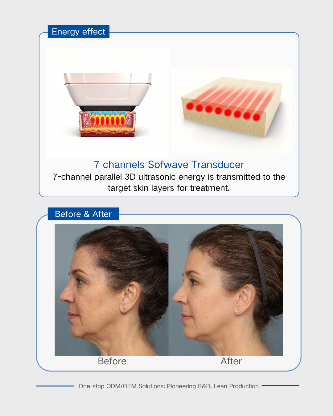 7 channels Sofwave Transducer 7 channels Sofwave Transducer