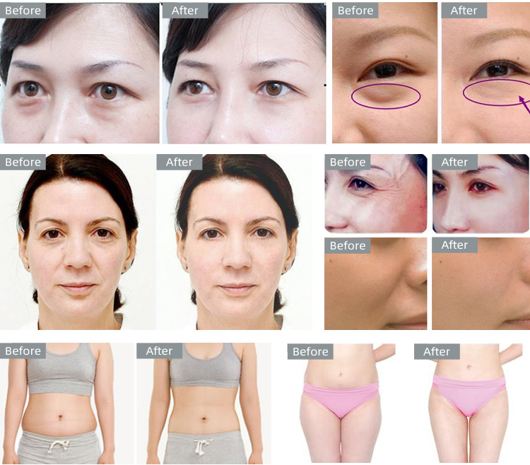 3in1 radiofrequency and body cavitation machine 3in1 radiofrequency and body cavitation machine