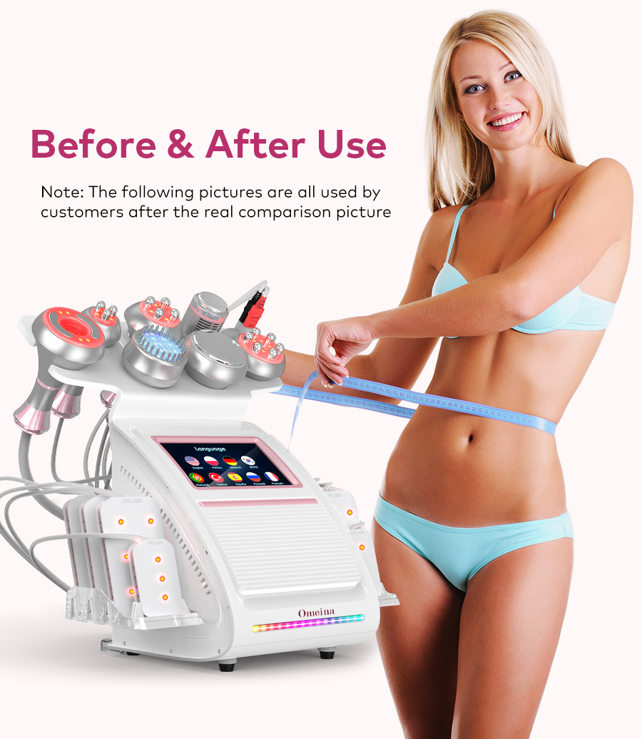Omeina ultrasonic cavitation before and after Omeina ultrasonic cavitation before and after