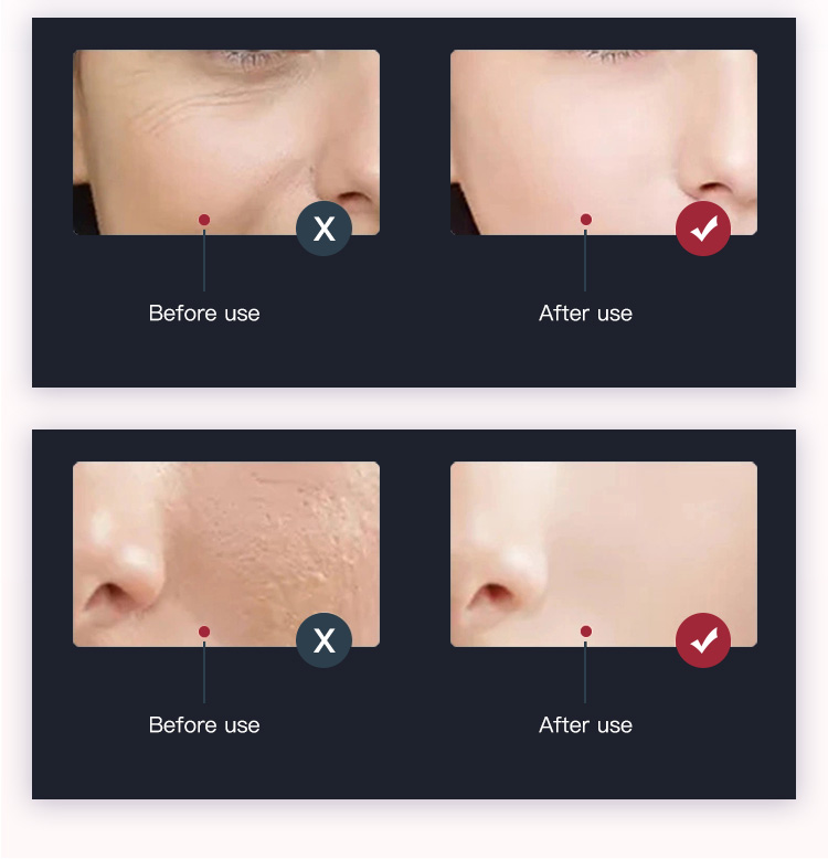 acne treatment acne treatment