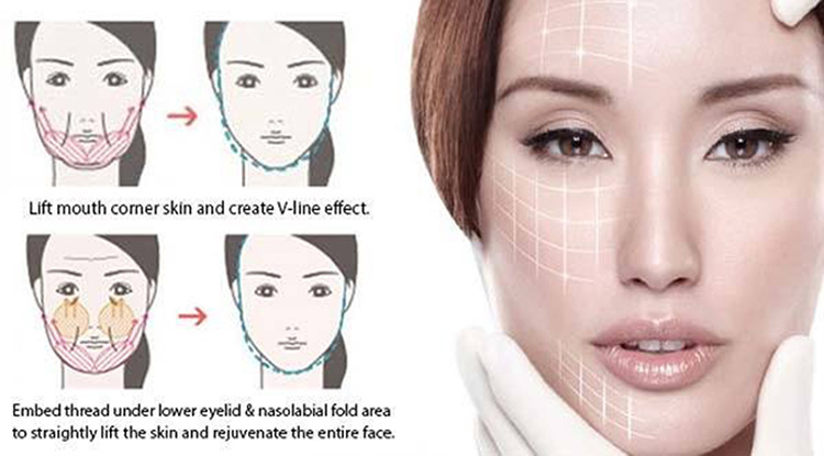 Ανελκυστήρας νήματος ΠΟΠ PDO Thread Lift