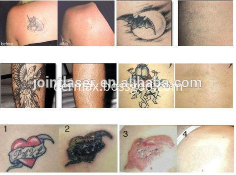 Nd Yag Laser for Tattoo Removal
