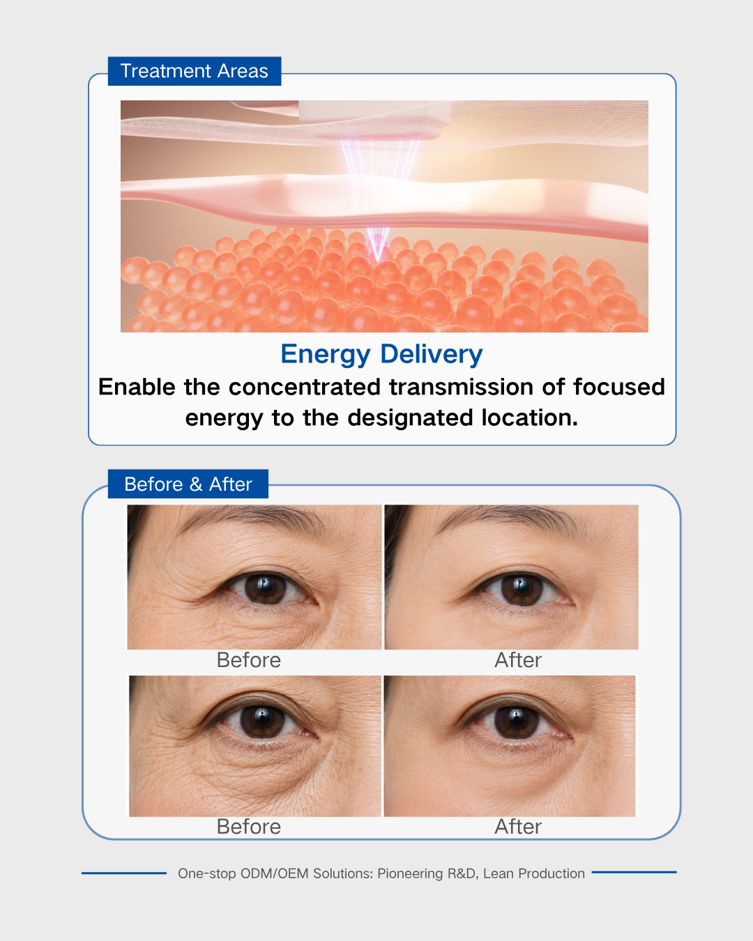 Ultherapy Transducer for Periorbital Tightening -2 Ultherapy Transducer for Periorbital Tightening -2