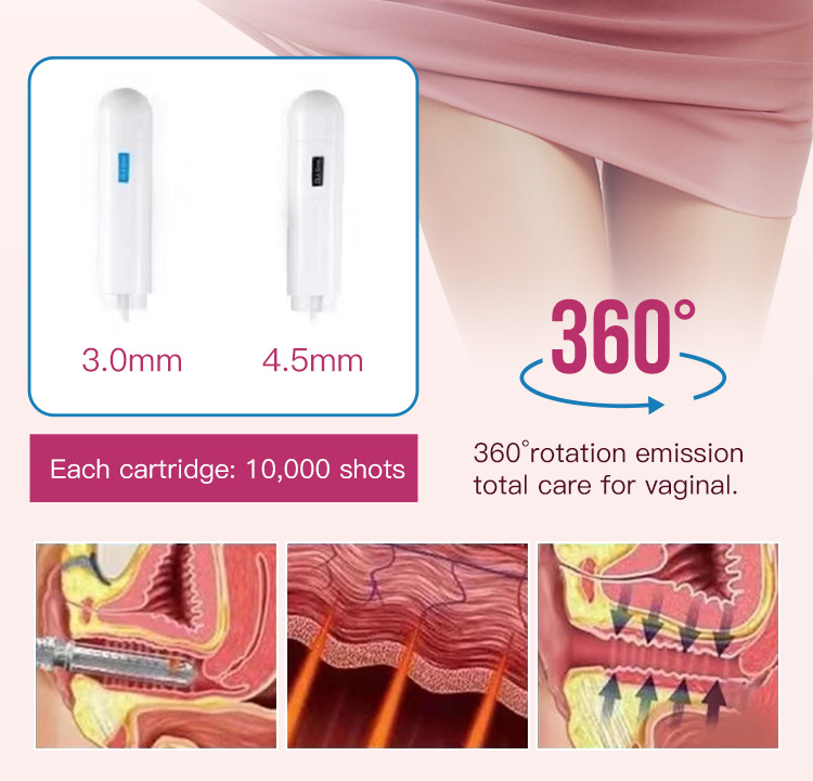hifu treatment hifu treatment