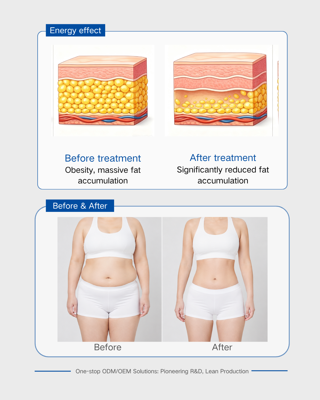 Focused Ultrasound Transducer for Fat Reduction- Focused Ultrasound Transducer for Fat Reduction-