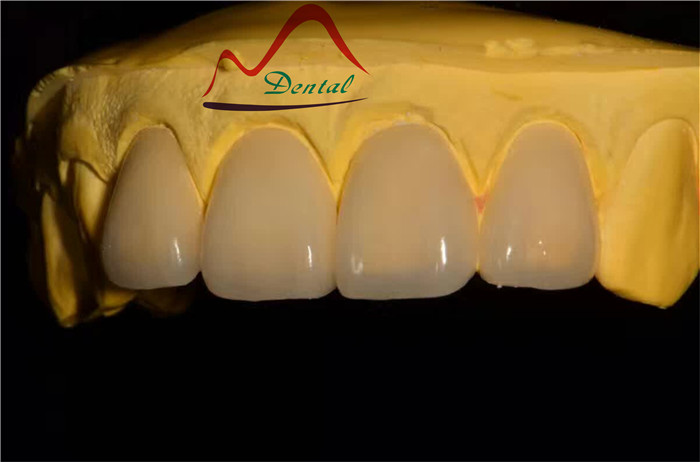 E-max supper thin veneers (4)