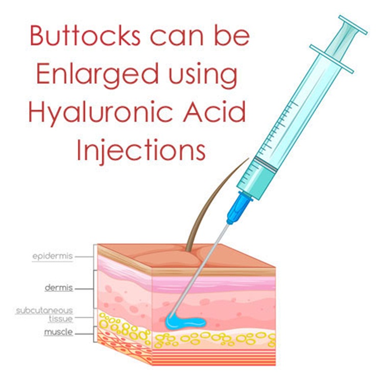 hyaluronzuur dermale vuller injectie hyaluronic acid dermal filler injection