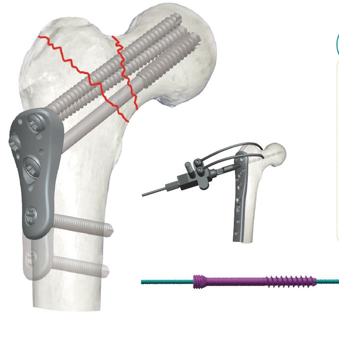 small proximal femure lateral polyaxial lcoking plate