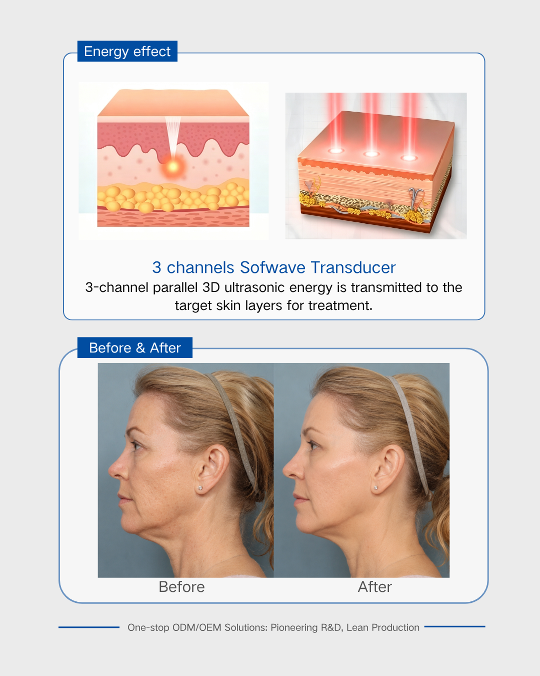 3 channels Sofwave Transducer 3 channels Sofwave Transducer