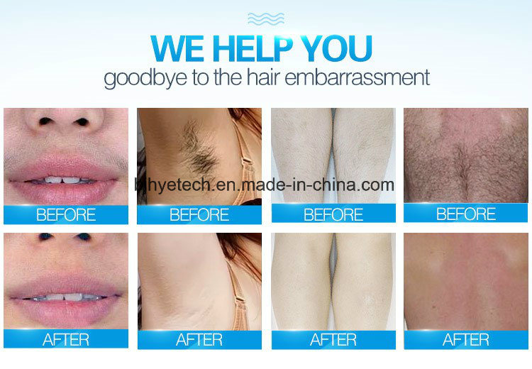 Best Quality Permanent Hair Removal 808nm Diode Laser Supplier