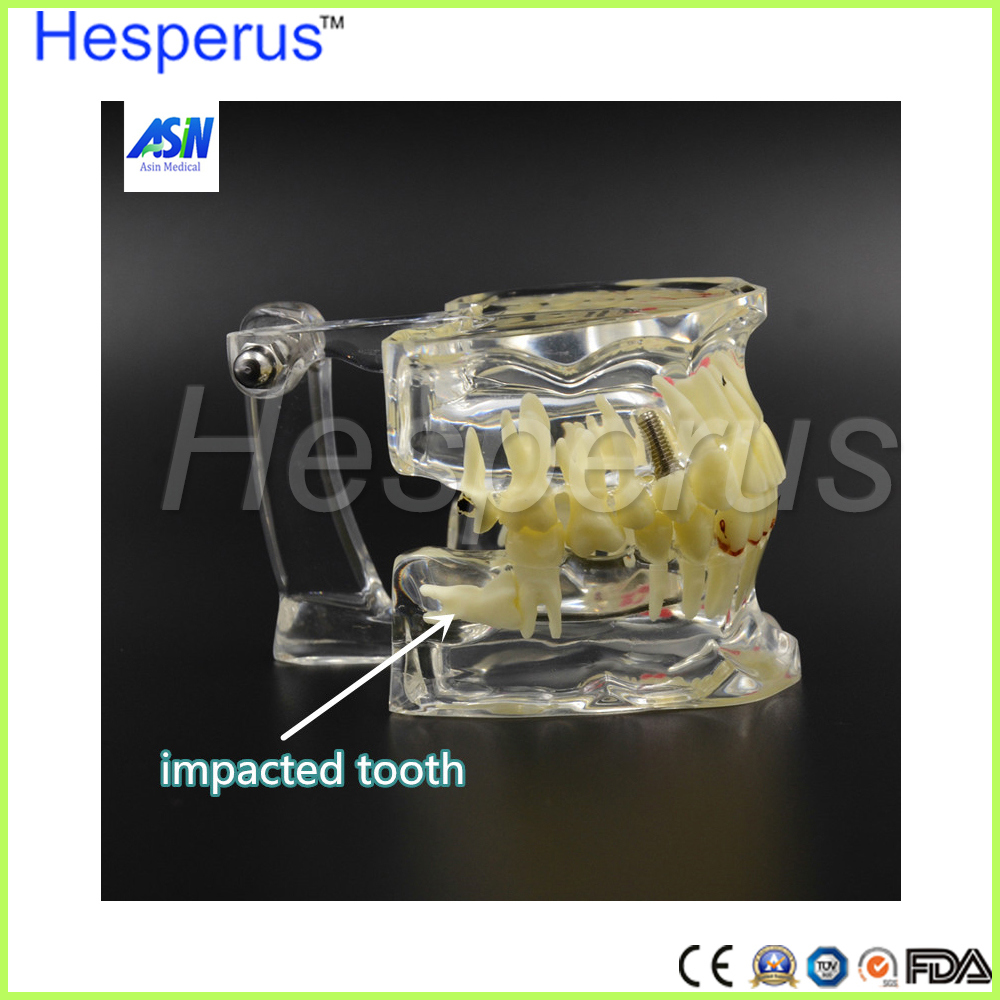 Dental Implant Teeth Dental Pathological Teeth Implant Model Hesperus