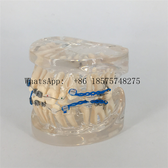 Malocclusion Model with Brackets Chain Wire Dental Tooth Model