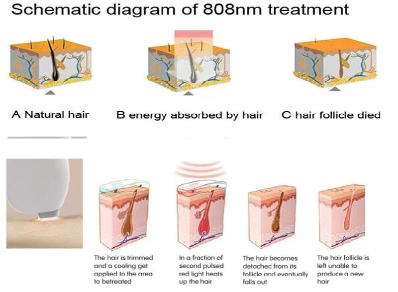 Professional Medical Portable 808nm for Permanent Hair Removal