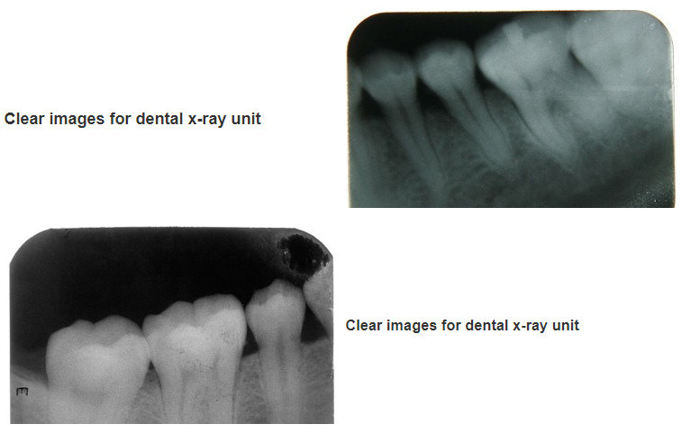 Mslk05 Portable Dental Xray Machine/ Xray Unit with Sensor System/Digital Dental Xray Sensor