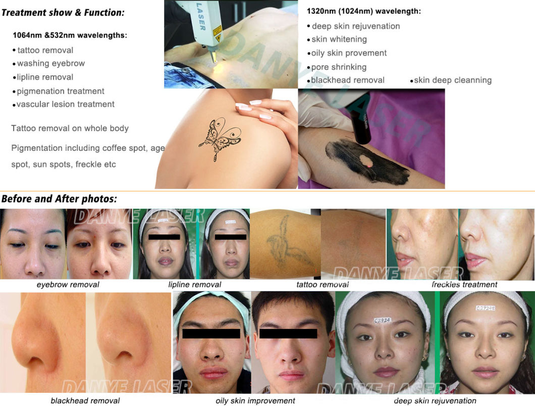 High Power and Best Laser Q Switch YAG Laser Tattoo Removal and Deep Skin Rejuvenation Black Face Therapy Machine