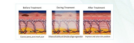 Dianfu Star 10 Times Effects of Laser Equipment CO2 Fractional