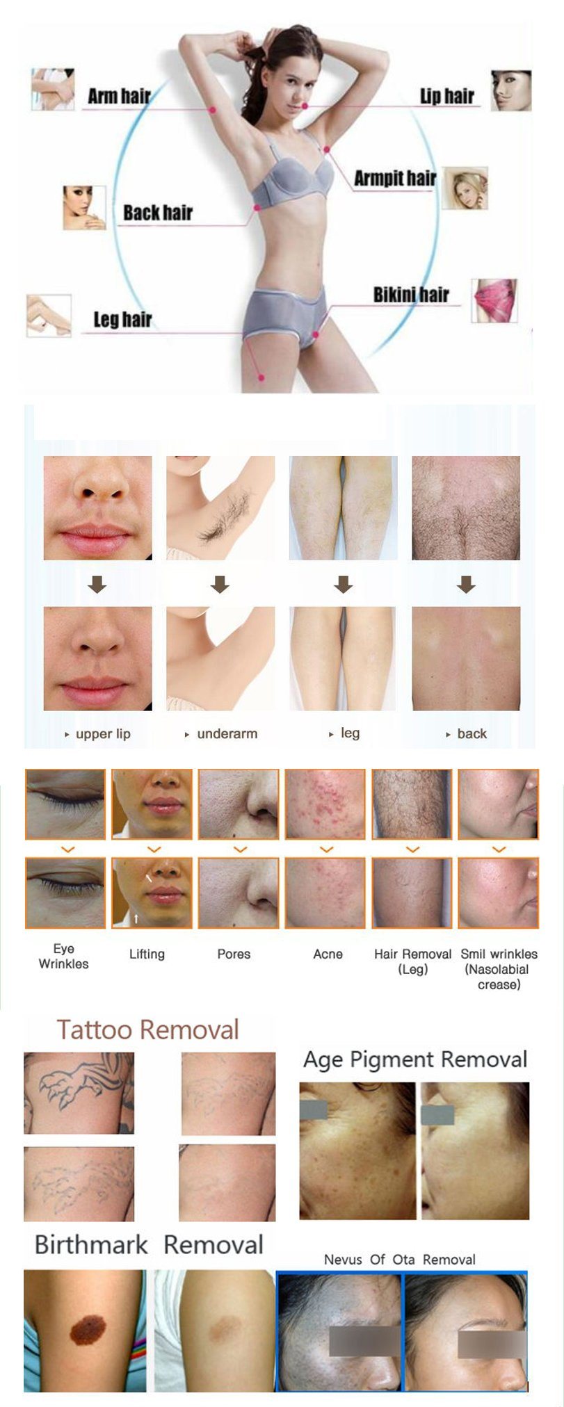 2018 Hot Sale Tattoo Removal Pigmentation Removal Acne Removal Hair Removal Shr IPL Opt RF Laser Beauty Machine for Skin Rejuvenation