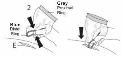 Disposable Surgical Wound Protector for Caesarean Operation