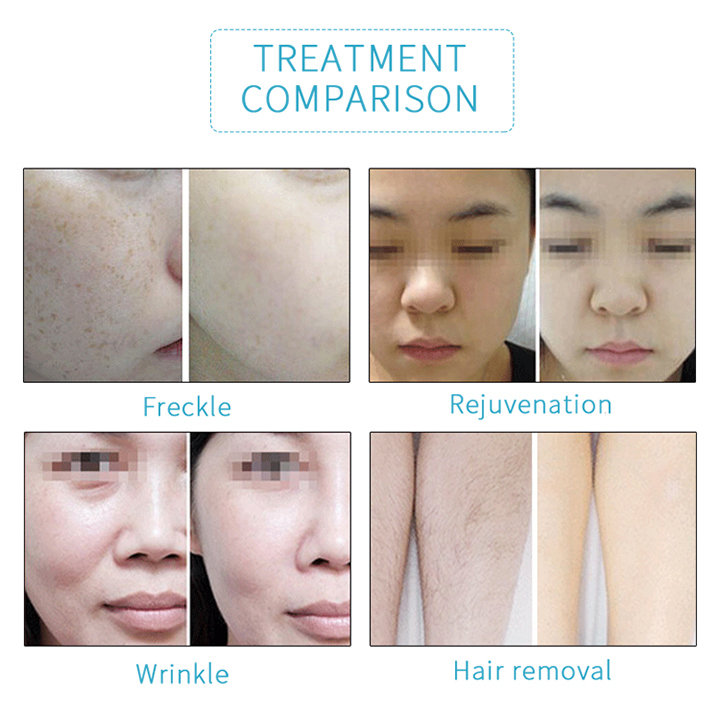 Permanent Easy Effective Hair Removal Options IPL Laser