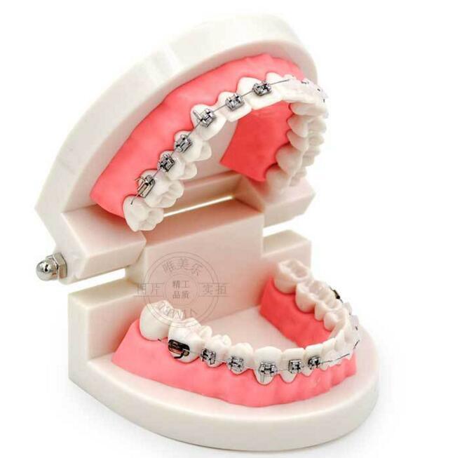 Dental Model of Teeth with Half Metal and Ceramic Bracket