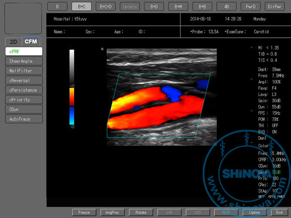 Color Doppler Ultrasound (DopScan 8000)