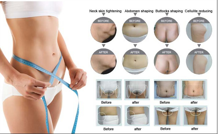 Body Contouring Fat Reduction Cavitation RF for Weight Slimming Loss Cryolipolysis Machine