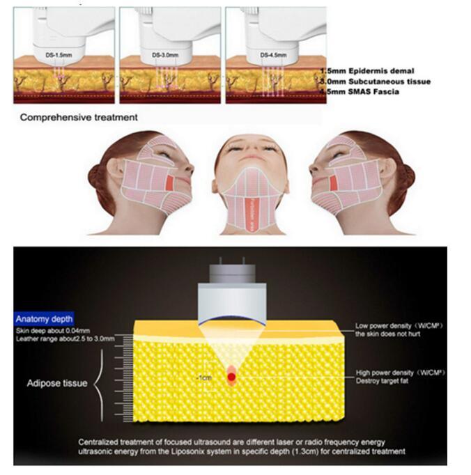Hifu for Wrinkle Removal and Face Lifting Machine