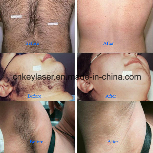 Wholsale High Quality 808nm Diode Laser Hair Removal Machine Factory Price