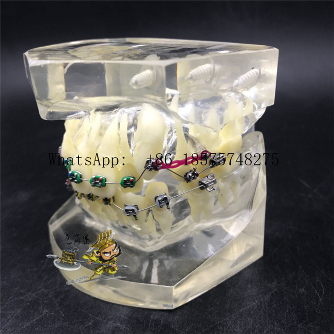 Malocclusion Model with Brackets Chain Wire Dental Tooth Model