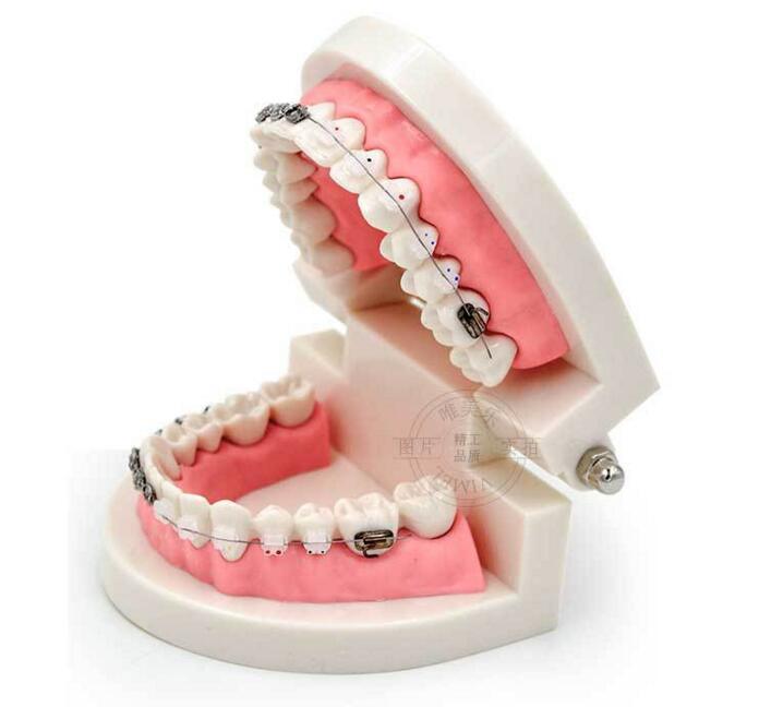 Dental Model of Teeth with Half Metal and Ceramic Bracket