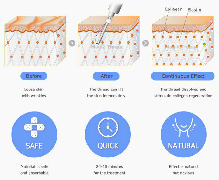 Custom Sterile Double Needle Face Lift Pdo Thread