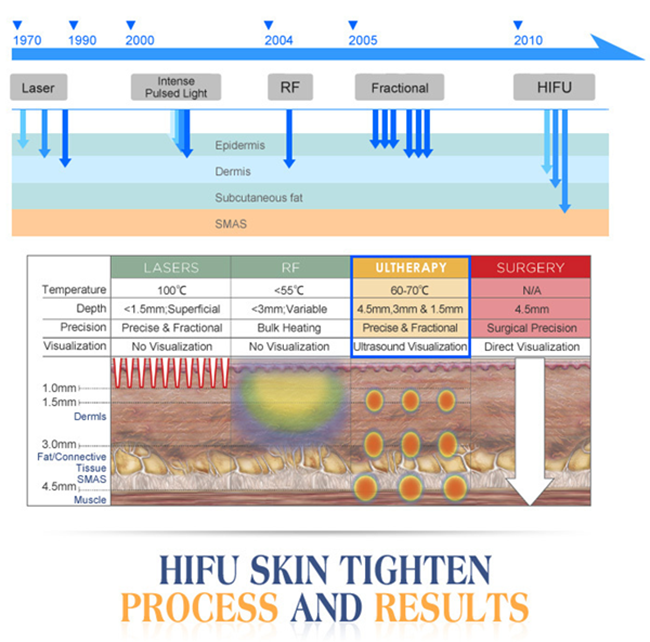 Professional Ultrasound Hifu Machine for Face Lifting