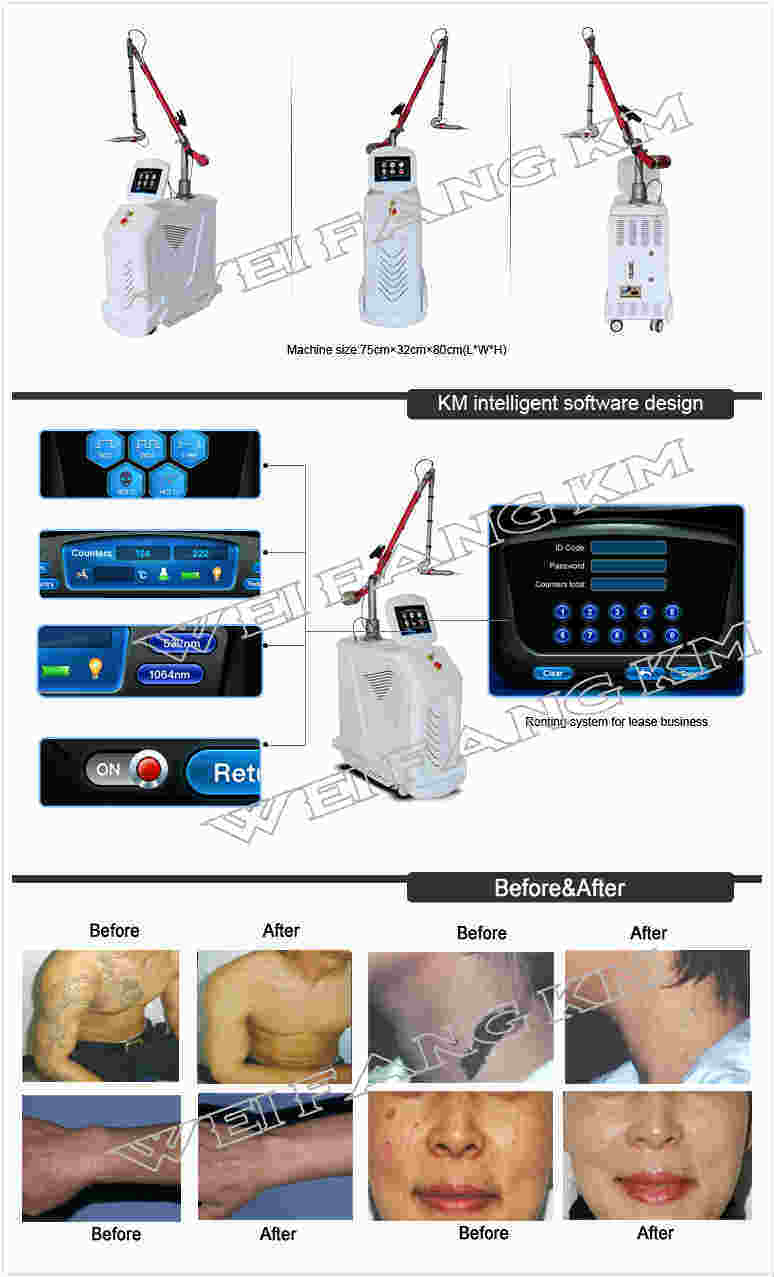 Medical Ce Tattoo Pigment Spots Removal ND YAG Laser Machine Prices