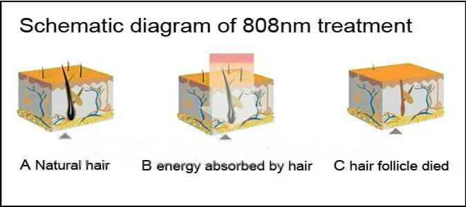 Warranty 20 Million Shots of Laser Diode 808nm Hair Removal Machine with Ce Supplier
