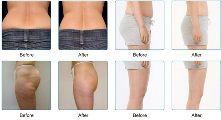 Cryolipolysis for Noninvasive Cellulite Reduction Powerful Machine