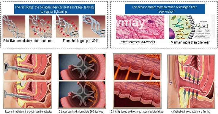 Vh613 CO2 Fractional Laser Vaginal Tightening Skin Rejuvenation Machine