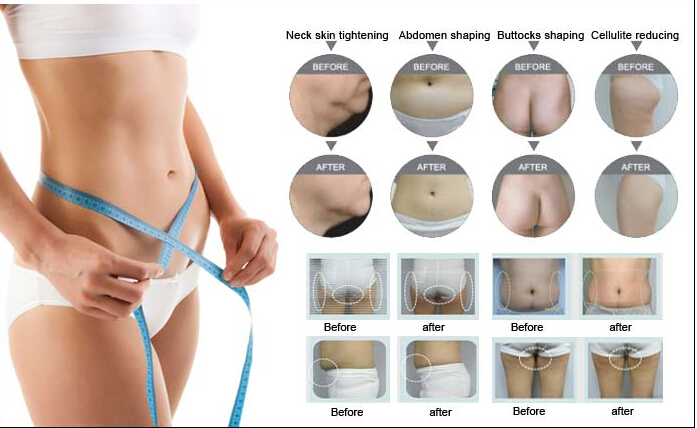 Cavitation Vacuum with RF Slimming