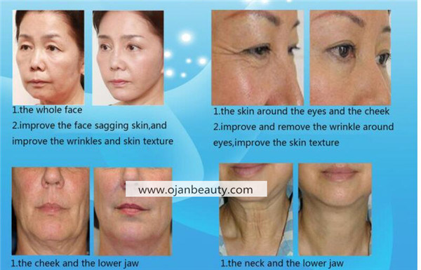 Best Anti-Aging High Intensity Focused Ultrasound Hifu Wrinkle Removal