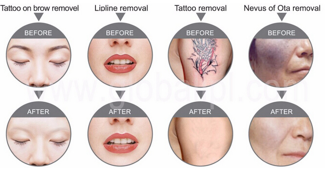 Hot Sale Hair and Tattoo Removal Laser/ Elight IPL Shr Laser/ Q Switch ND YAG Laser