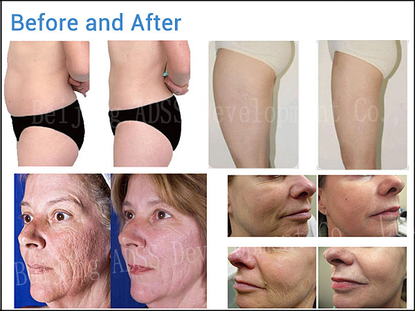 Home Use Velashape Facial Beauty Machine to Lose Weight
