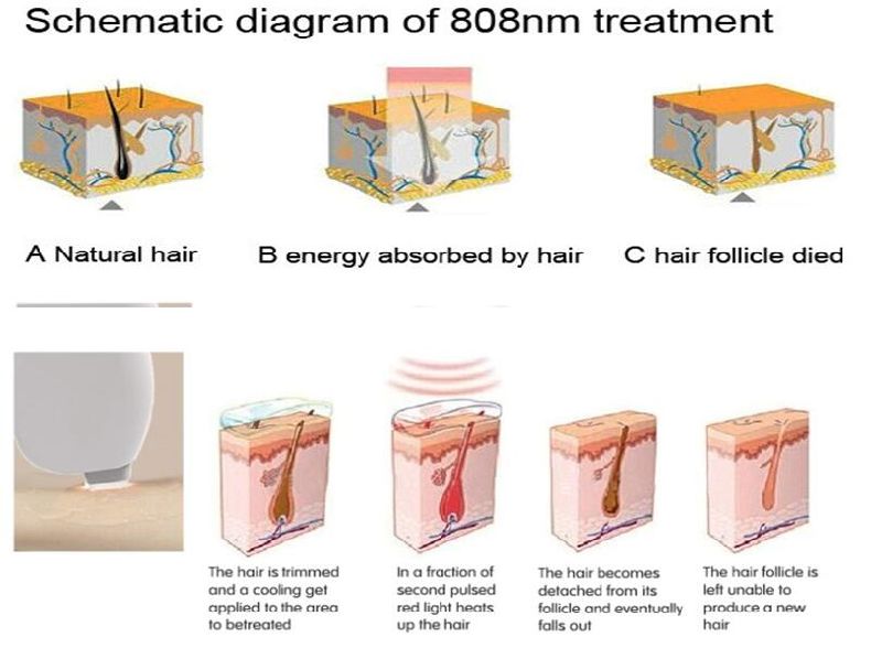 2018 Professional 808nm Hair Removal