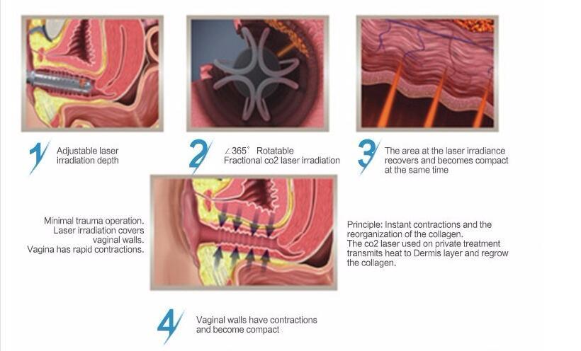 Vaginal Tightening Fractional CO2 Laser Machines