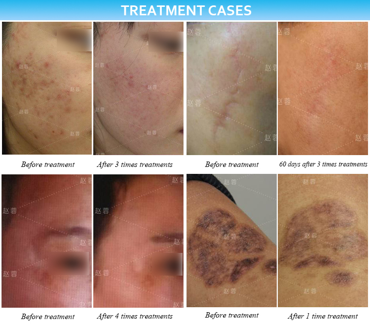 Plasma Beauty Acne Scar Treatment Skin Tightening Wrinkle Removal Machine