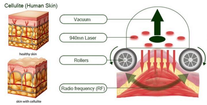 Effective Velasmooth Velashape RF Cavitation Vacuum Roller Body Slimming Machine for Sale