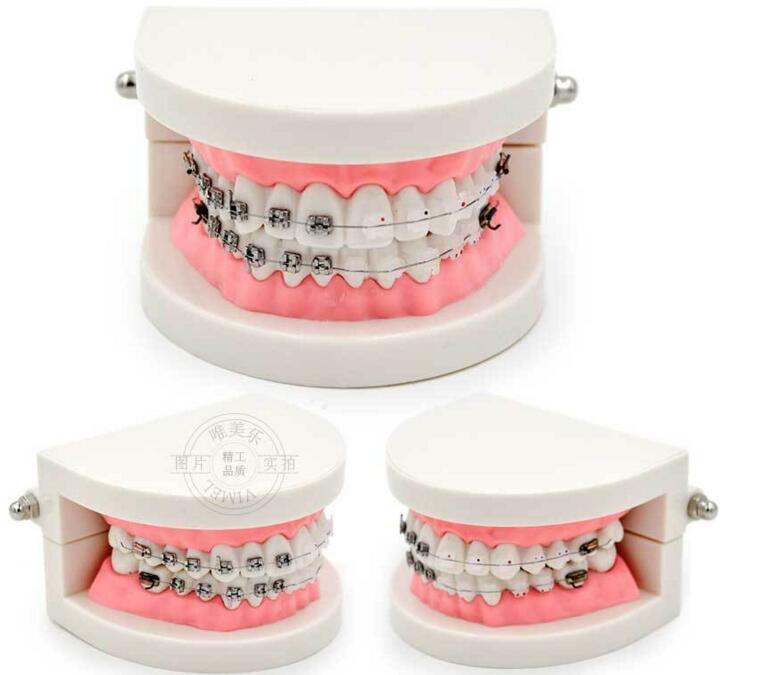 Dental Model of Teeth with Half Metal and Ceramic Bracket