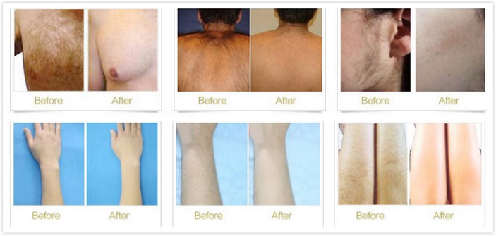 All Skin Type Permanent 808nm Hair Removal