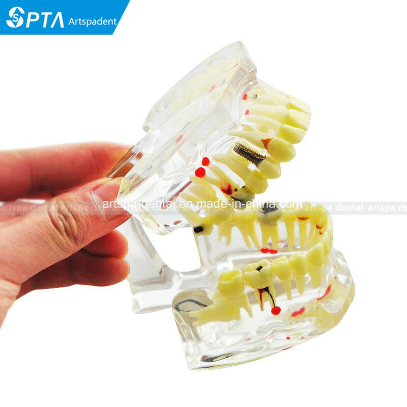 Dental Study Tooth Transparent Adult Pathological Teeth Model Dental Lab