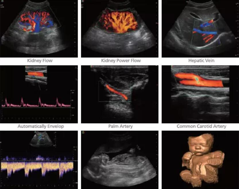 Sonoscape Ultrasonido Ecografo 4D Color Doppler Echo Machine