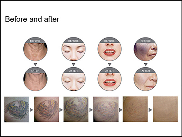 Fg2015 ND YAG Laser Freckle Freckle Tattoo Removal